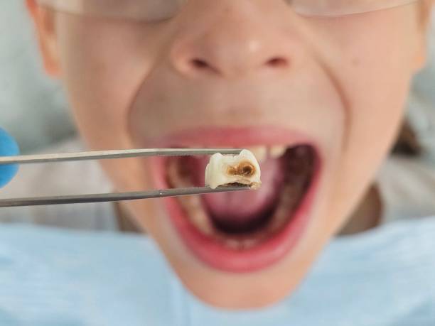 Best Urgent Tooth Repair  in Stroudsburg, PA
